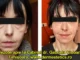 mezoterapie la Timișoara tratamente dermatologice